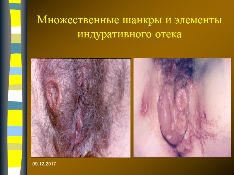 09.12.2017 Множественные шанкры и элементы индуративного отека